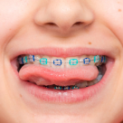 Aparatele dentare la copii: moft sau necesitate medicală? Ce spun studiile și practica ortodontică