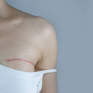 Cum decurge o reconstrucţie mamară, ultima etapă în tratarea cancerului de sân