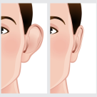 Otoplastia, singura operatie estetica ce se poate efectua din copilarie