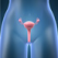 Terapia cu laser trateaza ovarele polichistice si infertilitatea