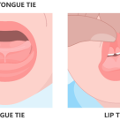 Frenectomia: Refacerea armoniei funcționale în cavitatea bucală