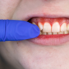 Tot ce trebuie să știi despre parodontoză și cum se poate trata cu ajutorul Florida Probe