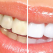 5 lucruri pe care ar trebui să le știi înainte de albirea dentară