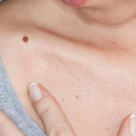 Alunițele și expunerea la soare - cum ne protejăm vara aceasta de cancerul de piele