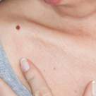 Alunițele și expunerea la soare - cum ne protejăm vara aceasta de cancerul de piele