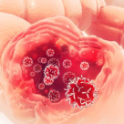 Cancerul colorectal - locul 3 în lume ca frecvență. Cum se tratează 