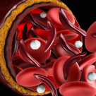 Siclemia la copii – anemia cu celule in secera