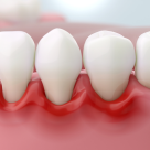 Tratamente naturiste pentru gingivită: ce îți poate calma gingiile inflamate, ce funcționează acasă și când ai nevoie de medic