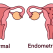 Polipii endometriali și sănătatea feminină