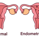 Polipii endometriali și sănătatea feminină