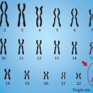 Sindromul X fragil – cauze, simptome