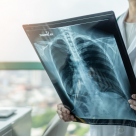 Persoanele care nu s-au tratat corespunzător de Covid pot prezenta fibroze pulmonare