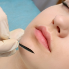 Mentoplastia - operatia de remodelare a barbiei 