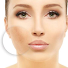 Principalele cauze care duc la hiperpigmentarea pielii