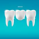 Fațete vs. coroane dentare – cum alegem cea mai potrivită soluție pentru un zâmbet sănătos și estetic