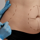 Când dietele nu mai ajută: poate fi liposucția soluția potrivită?