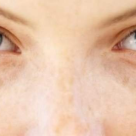 Melasma de sarcină - de ce apare și cum o putem preveni