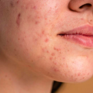 De ce inflamațiile gingivale pot „întuneca” tenul? Efectele gingivitei asupra pielii