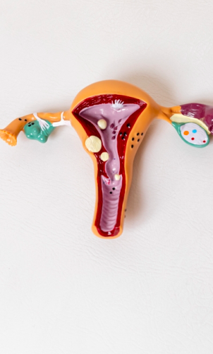 Fibrom uterin: tratamente naturiste, plante și remedii care pot completa îngrijirea medicală