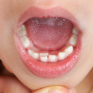 Ce sunt ”dinții de rechin”? Când, unde și de ce apar?