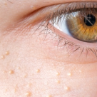 Punctele de grăsime de pe față - de ce apar și cum scăpăm de ele