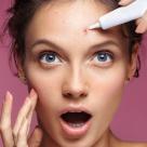 Tratamente pentru acnee: 6 soluții pentru tenul problematic