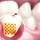 Retracția gingivală - prevenire și tratare