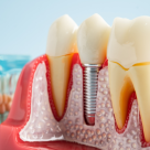 Implantul dentar, pas cu pas: de ce este important să înlocuiești dinții pierduți și de ce nu trebuie să te temi de procedură