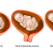 Placenta praevia: ce înseamnă și care sunt factorii care afectează placenta – explicații de la un medic ginecolog