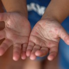 Boala Zahorsky sau herpangina la copii – cum se manifestă?