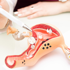 Stimularea ovariana – cand se recomanda