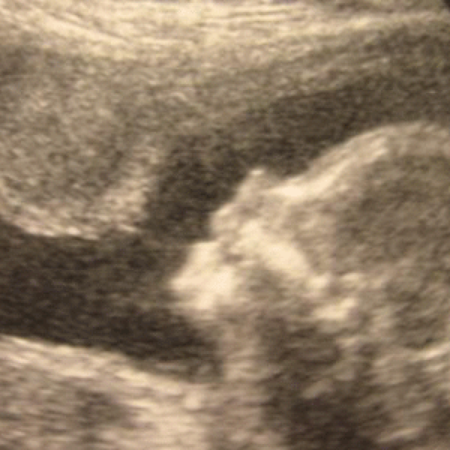 Adevar: Avortul creste riscul de cancer de col uterin
