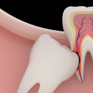 Molarii de minte - cand este necesara extractia lor?