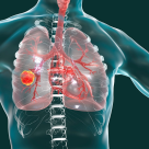 Campanie pentru depistarea precoce a cancerului bronhopulmonar: 50 de bronhoscopii gratuite efectuate lunar