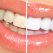 5 produse eficiente pentru albirea dentară acasă 