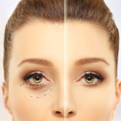 Combaterea cearcănelor: metode eficiente