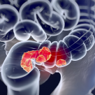 4 februarie a fost Ziua Mondială de Luptă Împotriva Cancerului. Care sunt simptomele cancerului colorectal?