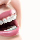 De ce sa porti aparat dentar chiar și când ești la vârsta adulta?