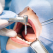 Mini implantul ortodontic - ce trebuie să știi despre acesta