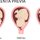 Placenta praevia - este cu adevărat un pericol pentru sarcină?