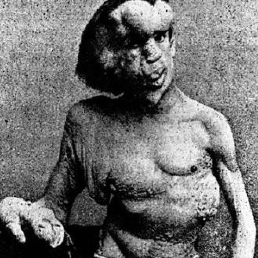 Acefalul Joseph Merrick