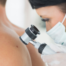 Cancerul de piele: cauze, manifestări și opțiuni de tratament