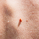 Papiloamele cutanate - factori care favorizeaza aparitia acestora 