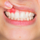 Gingii inflamate și dureroase. Ce trebuie să știi despre gingivită?